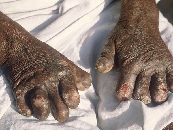 18.కుష్టు రోగం నయమయ్యేది